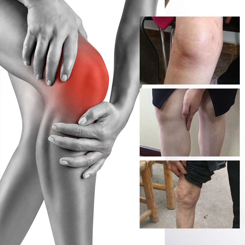 膝盖积液积水贴半月板滑膜关节膝盖疼痛贴膏神器足跟痛贴买2送1