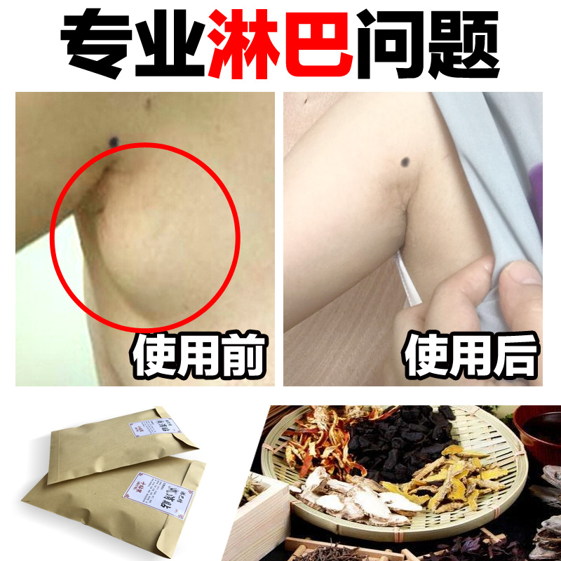 淋巴散结贴膏炎消贴淋巴结颈部结节肿大腋下副乳腮腺膏结核腹股沟