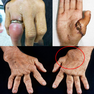 键鞘嚢肿手腕鼓包腱鞘舒筋贴大拇指疼关节健鞘炎手指专用痛舒贴膏