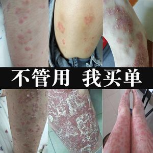 【大腿内侧股藓图片】大腿内侧股藓图片大全