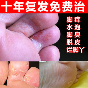 治腳氣真菌感染圖片