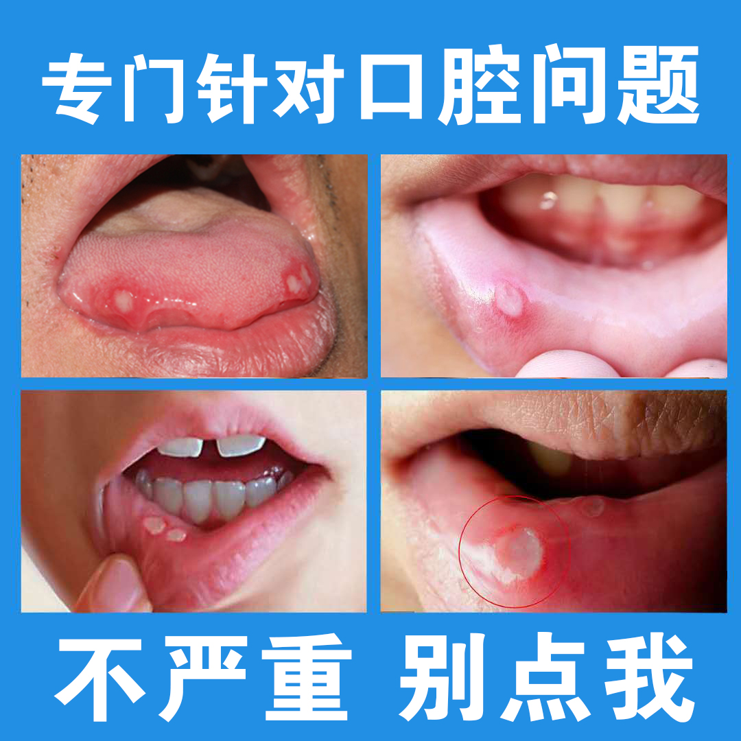 口腔上火嘴巴烂舌头起泡膏止疼喷剂30ml口腔粘膜修复防溃成人儿童