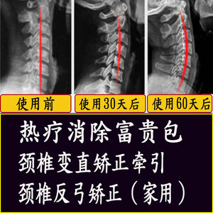 生理曲度变直睡眠修复还原颈椎理疗强直反弓矫