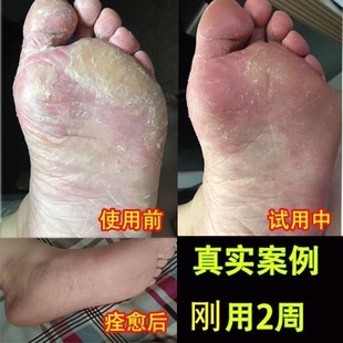 武汉南雪 汉雪金肤王抑菌软膏霜剂15g 脚气止痒软膏乳膏正品包邮