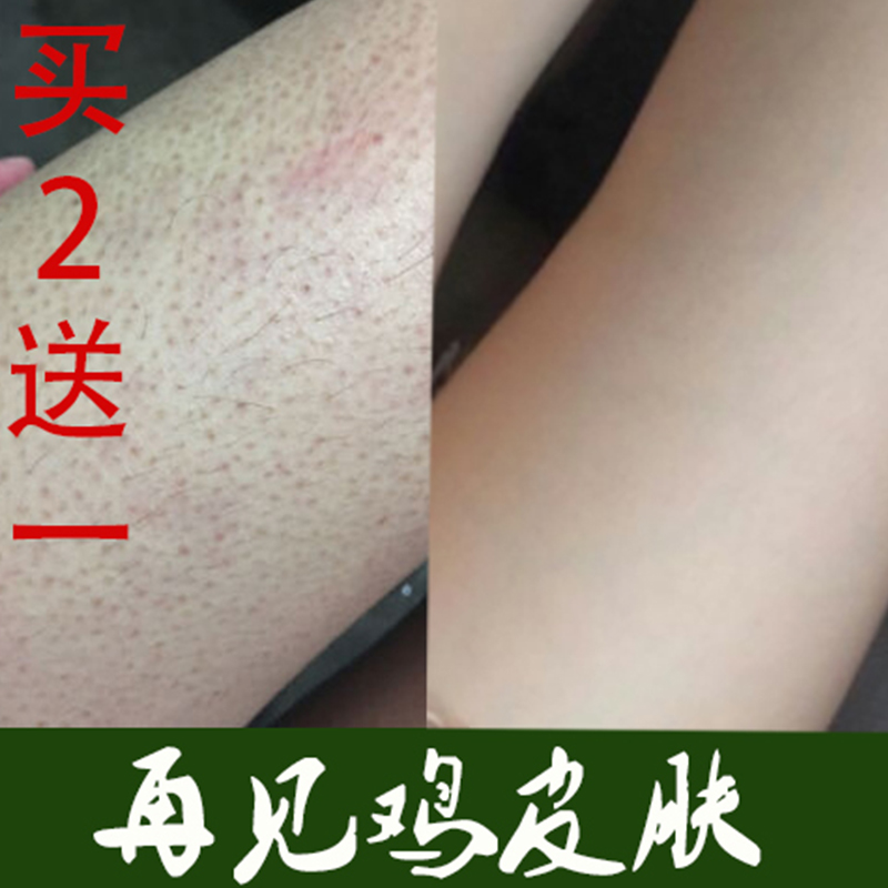 皮肤有鸡皮疙瘩用什么药膏(皮肤起鸡皮疙瘩用什么药可以擦)