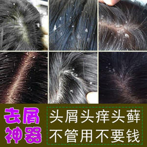 屑力轻洗发水去屑控油屑净洗发水大块头皮牛皮头部脂溢性止痒癣