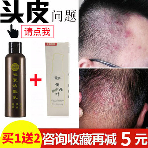class=h>水 /span>去疙瘩角质痘痘止痒去屑控油头臭掉头发正品