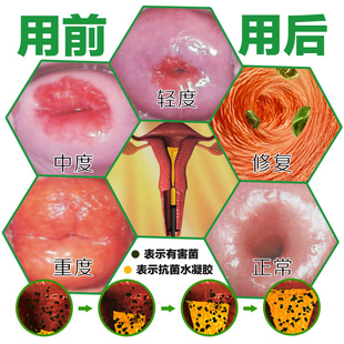 男女私处性病一扫光淋病梅毒疱疹克星喷剂治疗龟头包皮炎断根的药