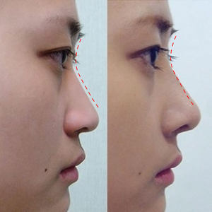 美鼻挺鼻梁挺鼻 span class=h>精油 /span>高鼻梁鼻子精华液隆山根